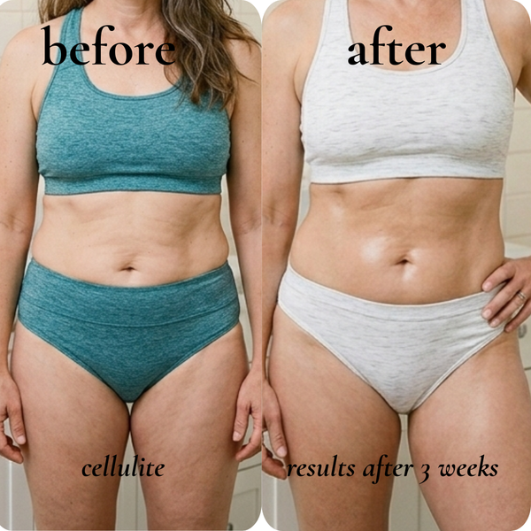 cellulite