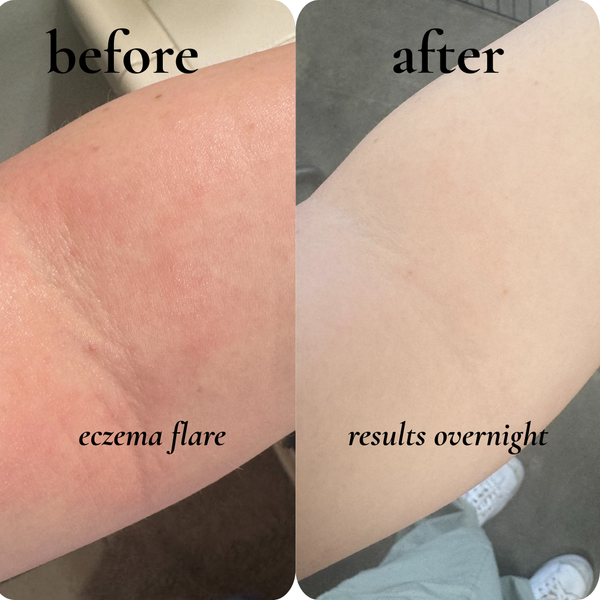 eczema + rashes