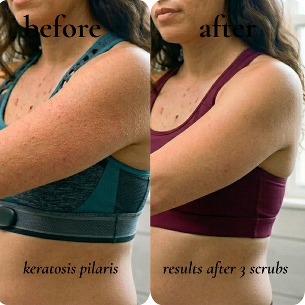 keratosis pilaris