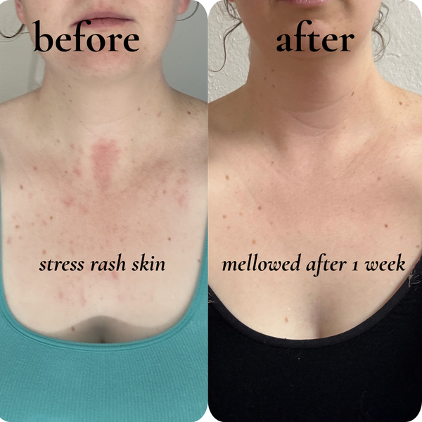 stress rash