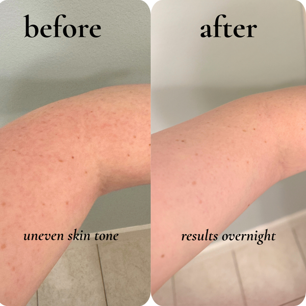 uneven skin tone